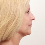 BroadBand Light Therapy (BBL) Before & After Patient #3849