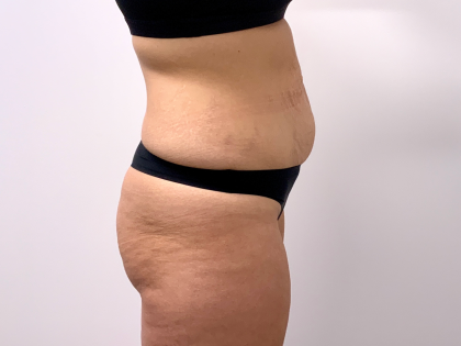 Tummy Tuck Before & After Patient #3820