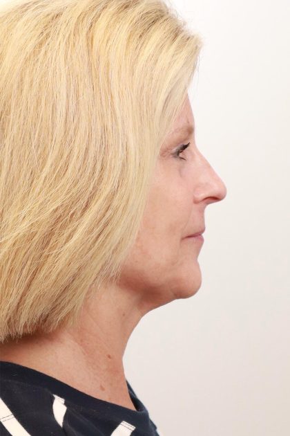 BroadBand Light Therapy (BBL) Before & After Patient #3849