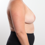 Breast Reduction Before & After Patient #3836