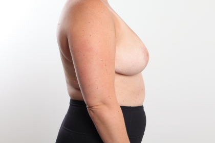 Breast Reduction Before & After Patient #3836