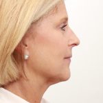 BroadBand Light Therapy (BBL) Before & After Patient #3849