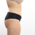 Tummy Tuck Before & After Patient #3820