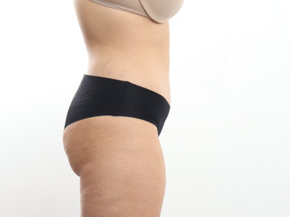 Tummy Tuck Before & After Patient #3820
