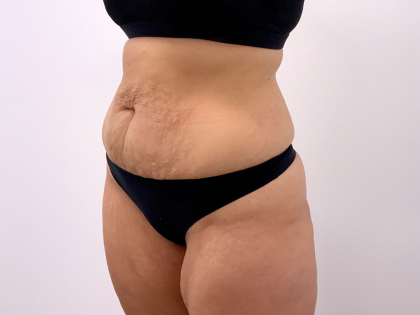 Tummy Tuck Before & After Patient #3820