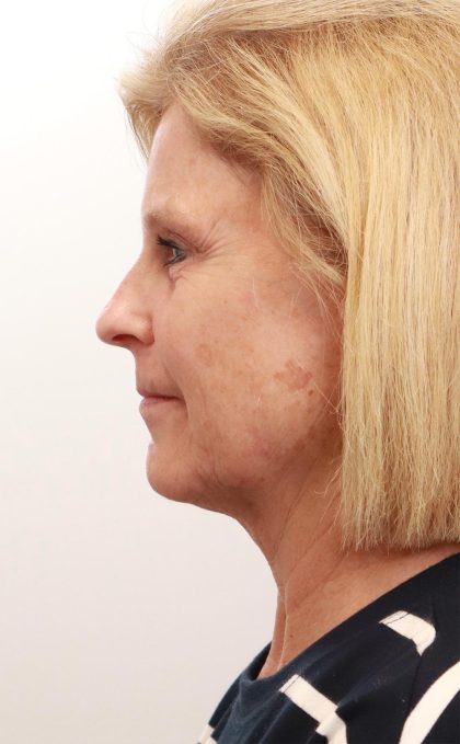 BroadBand Light Therapy (BBL) Before & After Patient #3849