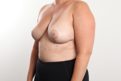 Breast Reduction Before & After Patient #3836