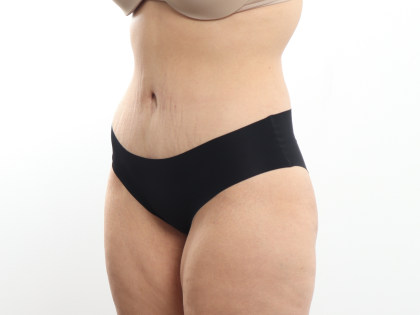 Tummy Tuck Before & After Patient #3820