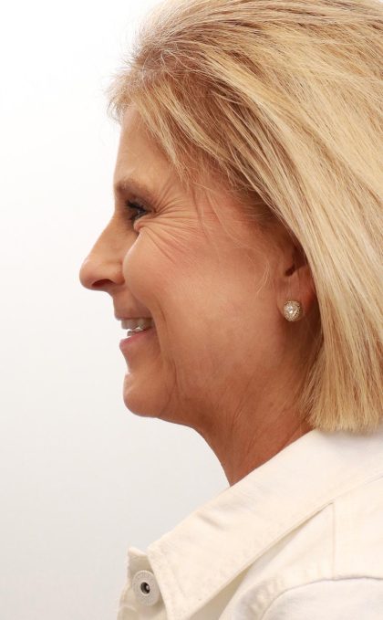 BroadBand Light Therapy (BBL) Before & After Patient #3849