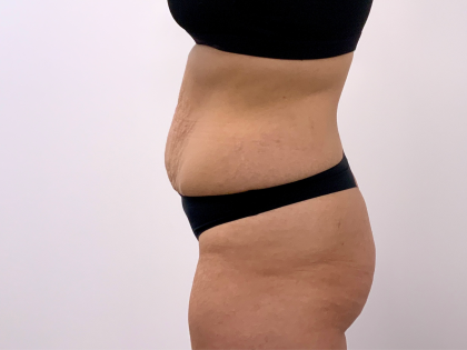 Tummy Tuck Before & After Patient #3820