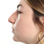Rhinoplasty Before & After Patient #3867