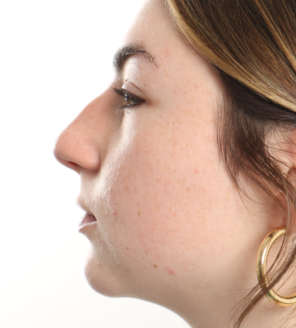 Rhinoplasty Before & After Patient #3867
