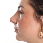 Rhinoplasty Before & After Patient #3867