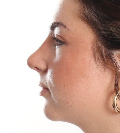 Rhinoplasty Before & After Patient #3867