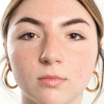 Rhinoplasty Before & After Patient #3867