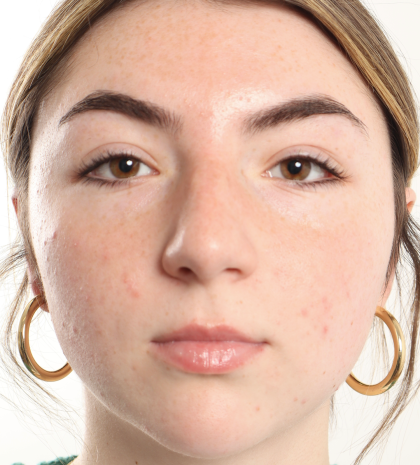 Rhinoplasty Before & After Patient #3867