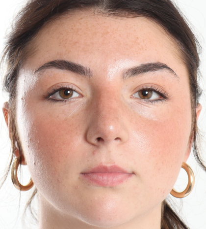 Rhinoplasty Before & After Patient #3867