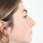 Rhinoplasty Before & After Patient #3867