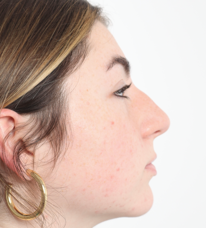 Rhinoplasty Before & After Patient #3867