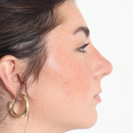 Rhinoplasty Before & After Patient #3867