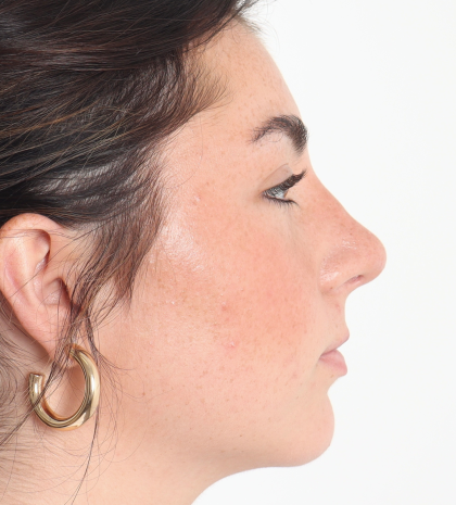 Rhinoplasty Before & After Patient #3867