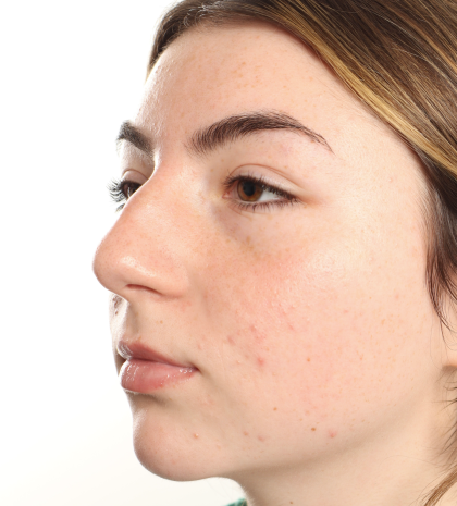 Rhinoplasty Before & After Patient #3867