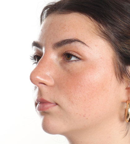 Rhinoplasty Before & After Patient #3867