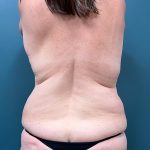 Liposuction Before & After Patient #3954