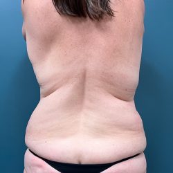 Liposuction Before & After Patient #3954