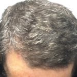 NeoGraft Before & After Patient #3917