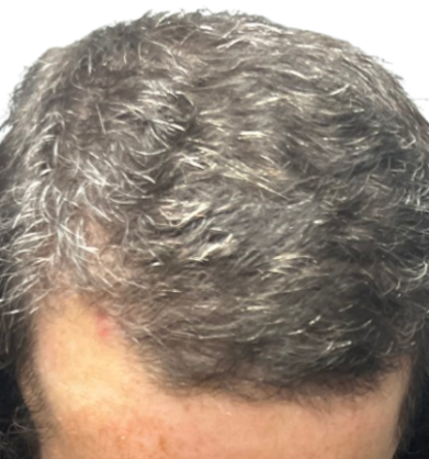 NeoGraft Before & After Patient #3917