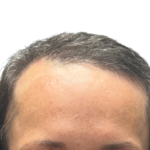 NeoGraft Before & After Patient #3917