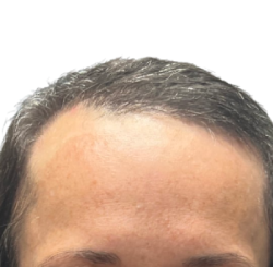 NeoGraft Before & After Patient #3917