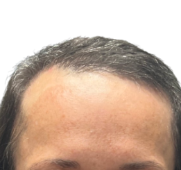 NeoGraft Before & After Patient #3917