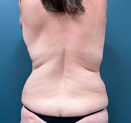 Liposuction Before & After Patient #3954