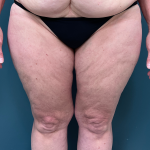 Thigh Lift Before & After Patient #3944