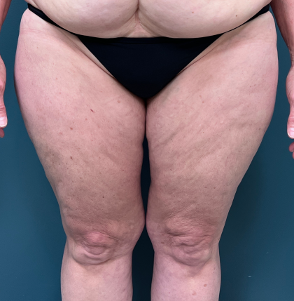 Thigh Lift Before & After Patient #3944