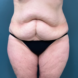 Tummy Tuck Before & After Patient #3948
