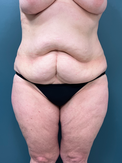 Tummy Tuck Before & After Patient #3948