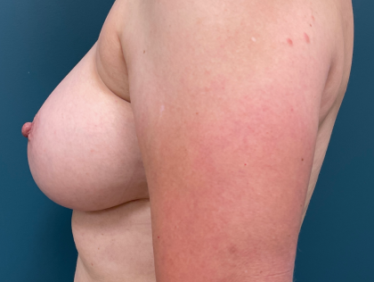 Breast Augmentation Before & After Patient #3930