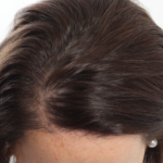 NeoGraft Before & After Patient #3917