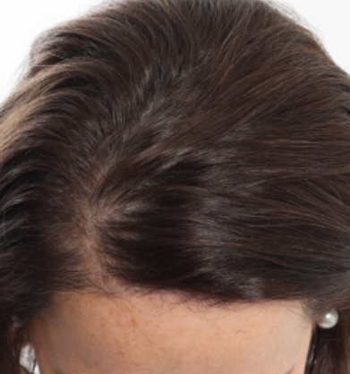 NeoGraft Before & After Patient #3917