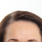 NeoGraft Before & After Patient #3917
