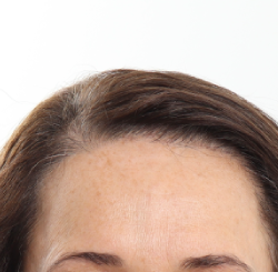 NeoGraft Before & After Patient #3917