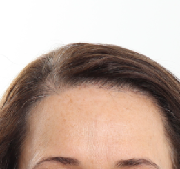 NeoGraft Before & After Patient #3917
