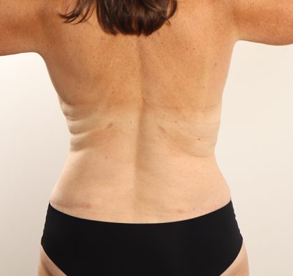 Liposuction Before & After Patient #3954