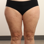 Thigh Lift Before & After Patient #3944