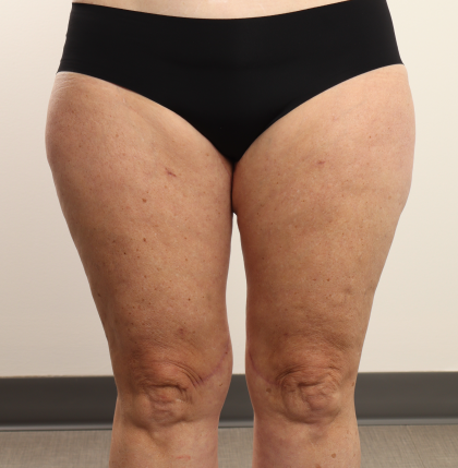 Thigh Lift Before & After Patient #3944