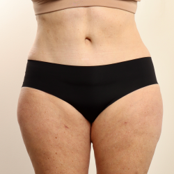 Tummy Tuck Before & After Patient #3948