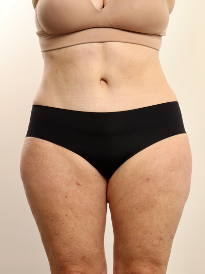 Tummy Tuck Before & After Patient #3948